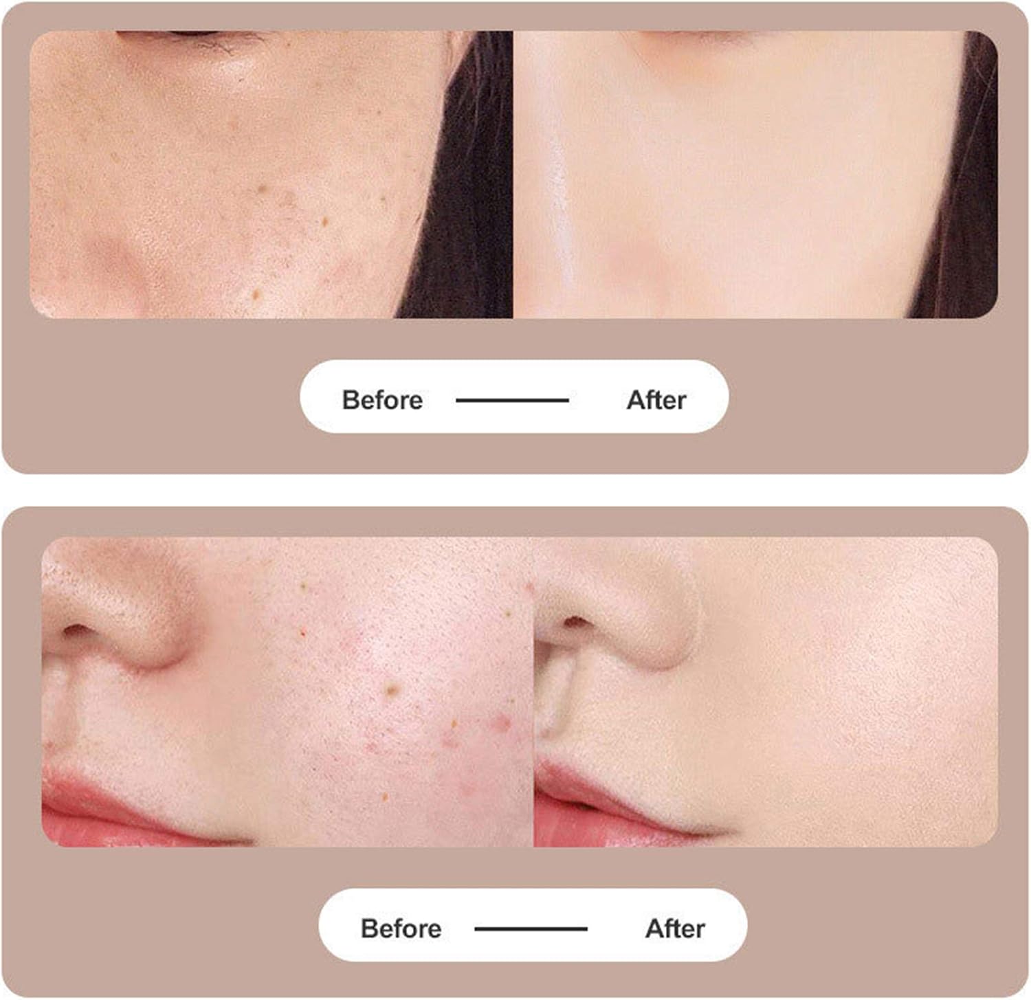 Лазерна косметична ручка LY-1368 для обличчя ∙ Плазмова лазерна ручка LY-1368 - мініатюра 7