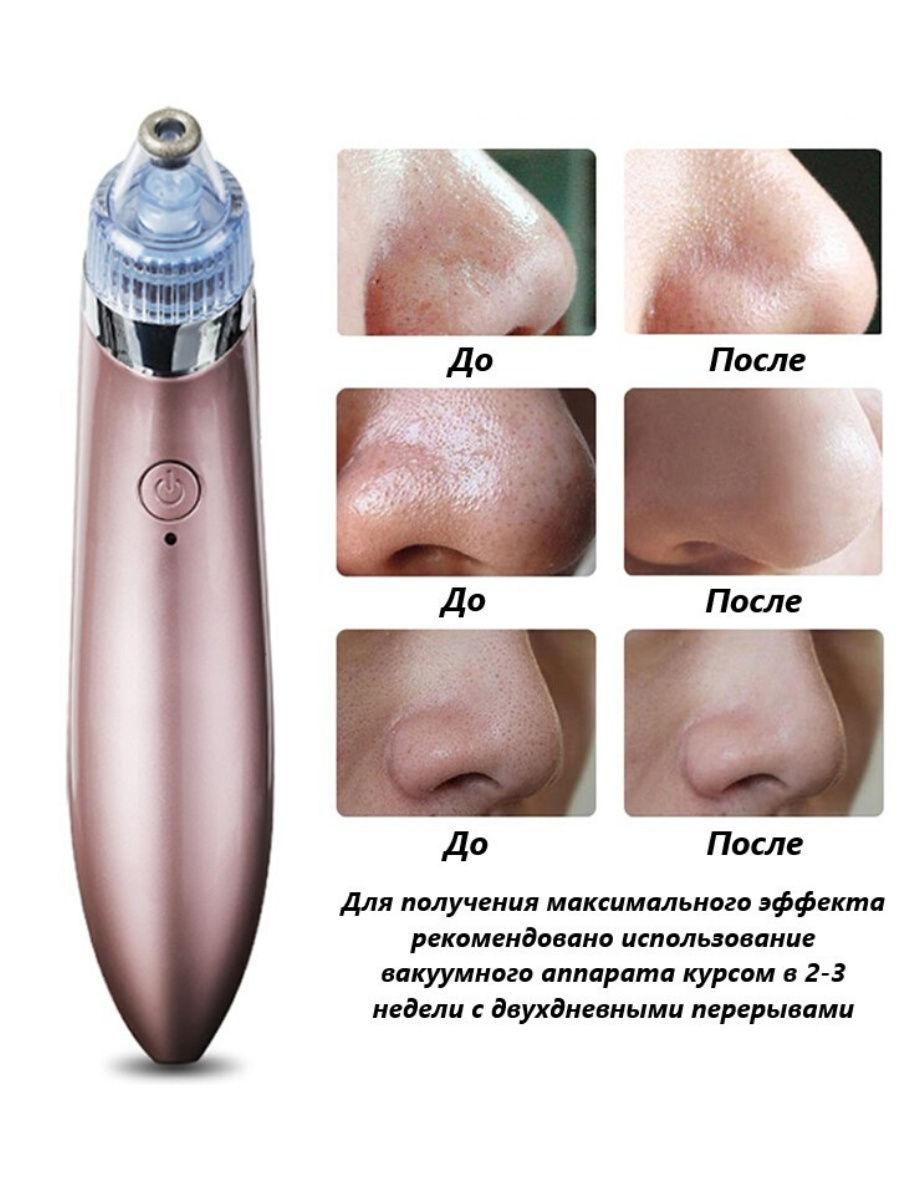 Апарат для вакуумного чищення пор обличчя Plymex XN-8030 від чорних точок та вугрів - мініатюра 3